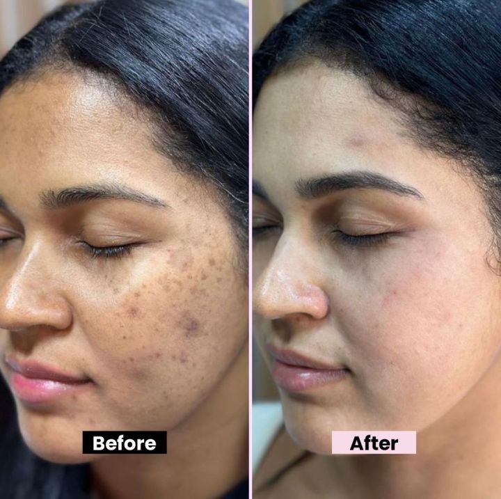 Kojic%20Acid%20Cream%20for%20Dark%20Spots%20&%20Hyperpigmentation%20Skin%20Brightening%20&%20Acne%20Scar%20Remova%20Vitamin%20B5%20-%20Image%204