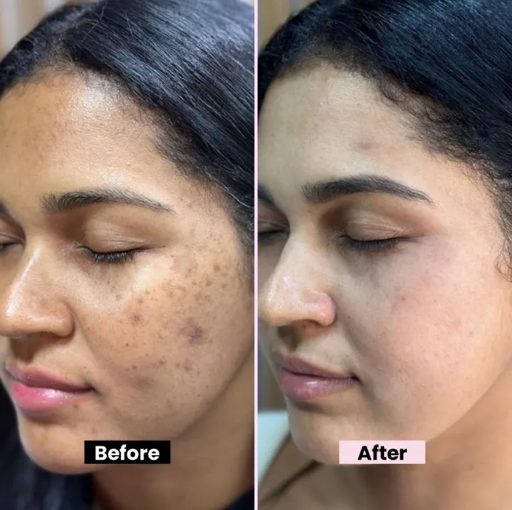 Kojic%20Acid%20Cream%20for%20Dark%20Spots%20&%20Hyperpigmentation%20Skin%20Brightening%20&%20Acne%20Scar%20Remova%20Vitamin%20B5%20-%20Image%204