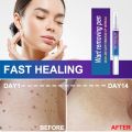 Warts Removal Pen Eliminate Wart Pen Wart Liquid Hand Foot Warts Remove Filiform Warts Flat Warts Condyloma Acuminatum. 