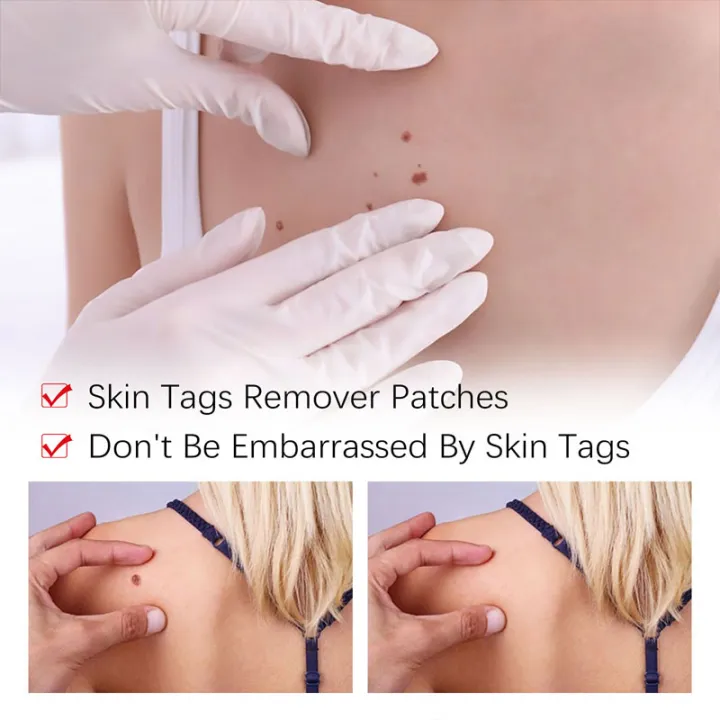Removal%20Of%20Warts%20Liquid%20Pen%20Woman%20Skin%20Care%20Removing%20Against%20Moles%20Patch%20Remove%20Black%20Dot%20Emulsion%20-%20Image%203
