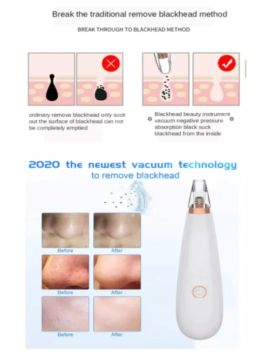 Blackhead%20Remover%20Facial%20Deep%20Pore%20Cleaner%20Vacuum%20Suction%20Removal%20Facial%20SPA%20Diamond%20Beauty%20Tool%20Skin%20Care%20Electric%20Blackhead%20Remover%20Acne%20Pimple%20Pore%20Cleaner%20Vacuum%20Suction%20Tool%20Blackhead%20Removal,%20Nose%20Sucking%20Machine%20Blackheads%20Removal%20Device%20Derma%20Roll%20-%20Image%209