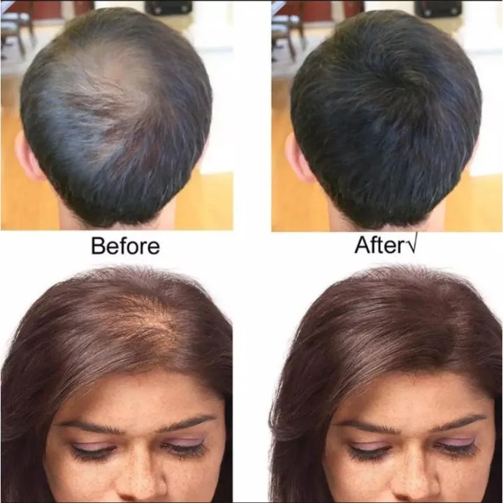 King%20caboki%20Hair%20Fibers%20Dark%20Bronw%2027.5g%20Pack%20of%203%20Fill%20In%20Fine%20and%20Thinning%20Hair%20for%20an%20Instantly%20Thicker%20&%20Fuller%20Look%20-%20Best%20Value%20&%20Superior%20Formula%20for%20Women%20&%20Men%20alternative%20of%20toppik%20-%20Image%203
