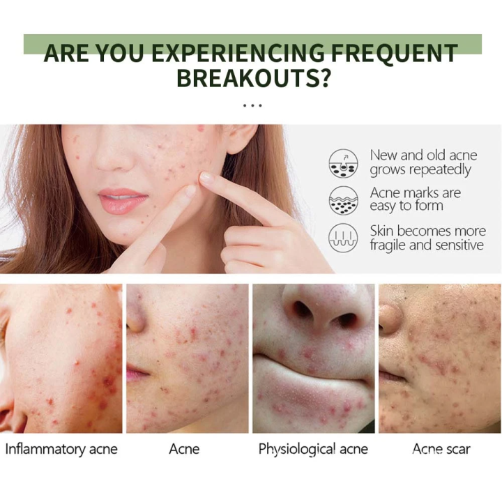 UPTOWN%20LA%20Anti%20Acne%20Cream%20%20for%20Acne%20Prone%20Skin%20and%20Acne%20Scars%20Marks%20with%20Niacinamide%20and%20Salicylic%20Acid%20%7C%20Anti%20Acne%20Face%20Treatment%20for%20Dark%20Spots%20%7C%2030%20ml%20-%20Image%204