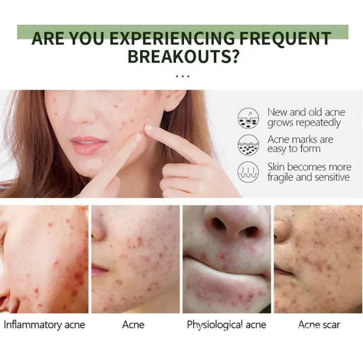 UPTOWN%20LA%20Anti%20Acne%20Cream%20%20for%20Acne%20Prone%20Skin%20and%20Acne%20Scars%20Marks%20with%20Niacinamide%20and%20Salicylic%20Acid%20%7C%20Anti%20Acne%20Face%20Treatment%20for%20Dark%20Spots%20%7C%2030%20ml%20-%20Image%204