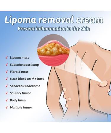 Lipoma%20Removal%20Cream%20%7C%20Advanced%20Lipoma%20Treatment%20Cream%20%7C%20Safe%20&%20Gentle%20Use%20-%20Image%204