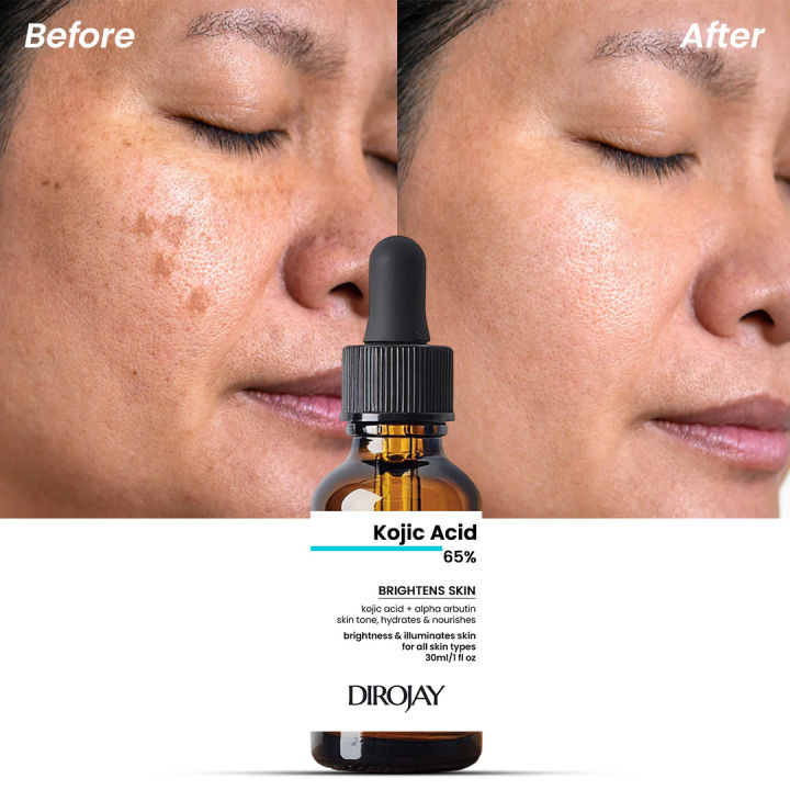 Kojic Acid Serum 65% – Skin Brightening & Dark Spot Corrector with ...