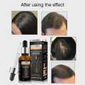 Pei Mei Hair Growth Essential Oil – Anti Hair Fall, Fast Hair Regrowth, Strengthening & Nourishing Scalp Treatment Serum for Men & Women. 