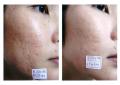 Derma Roller For Body And Face And Eye Titanium Micro Needles Skin Dermaroller. 