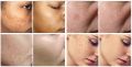 Trimo-skin Cream for Girls Face Pack of 4 | Scar Removal | Hyperpigmentation | Melasma Removal | Skin Care Products | It is applied to the skin and works to even out the skin tone.. 