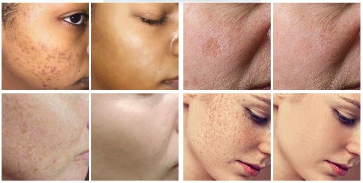 Trimo-skin%20Cream%20for%20Girls%20Face%20Pack%20of%204%20%7C%20Scar%20Removal%20%7C%20Hyperpigmentation%20%7C%20Melasma%20Removal%20%7C%20Skin%20Care%20Products%20%7C%20It%20is%20applied%20to%20the%20skin%20and%20works%20to%20even%20out%20the%20skin%20tone.%20-%20Image%206