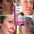 Organic Rosehip Seed Oil For Face-Pure Cold Pressed Facial Oil,Natural Non-Greasy Moisturizing Face Skin Care Serum New. 