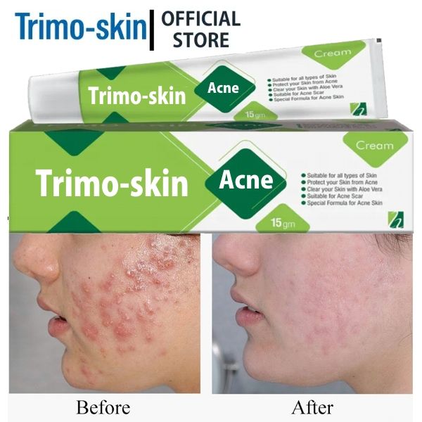 Anti Acne Face Treatment for Dark Spots Acne Shrink & Acne Scar Remove Cream: Skin Care Product