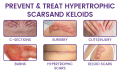 Timilk RegenScar Cream | Advanced Scar Removal Cream | Acne Marks, Stretch Marks & Dark Spots Treatment | Skin Repair Formula. 