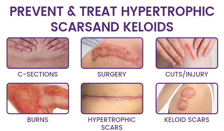 Timilk%20RegenScar%20Cream%20%7C%20Advanced%20Scar%20Removal%20Cream%20%7C%20Acne%20Marks,%20Stretch%20Marks%20&%20Dark%20Spots%20Treatment%20%7C%20Skin%20Repair%20Formula%20-%20Image%208