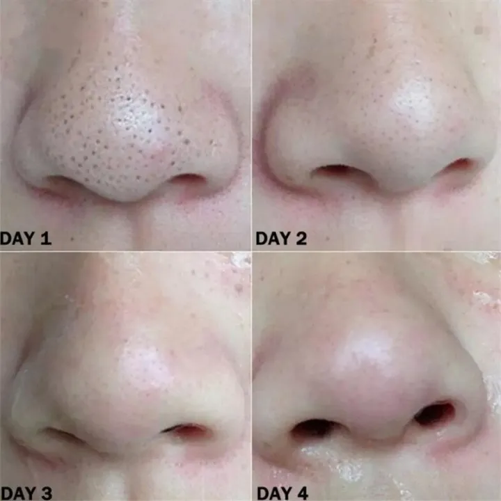 10pcs%20Nose%20Blackhead%20Remover%20Strips%20Mask%20Skin%20Care%20Shrink%20Pore%20Acne%20Treatment%20Mask%20Deep%20Nose%20Pore%20Cleansing%20Strips%20Black%20Head%20Remover%20-%20Image%206