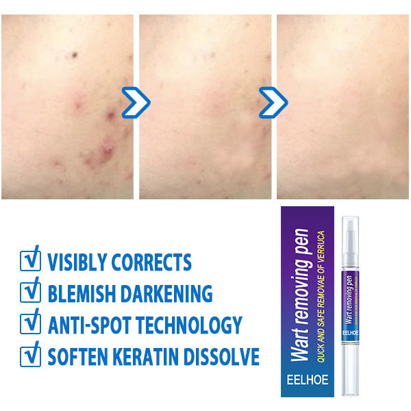 Wart%20Removal%20Pen%20%E2%80%93%20Liquid%20Treatment%20for%20Hand%20&%20Foot%20Warts%20-%20Image%204