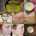Nixoderm cream For Skin Problem (10g) Acne spots, water blisters, feet bites, itchy rash. 