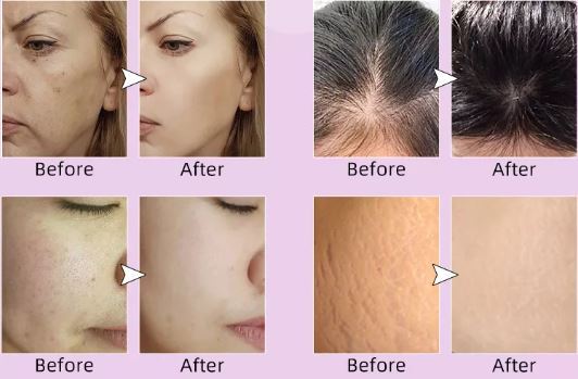 Derma%20Roller%200.5mm/1.0mm%20with%20540%20micro%20needle%20for%20hair%20&%20skin%20Therapy%200.5mm%20-%20Image%205