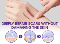 Timilk RegenScar Cream | Advanced Scar Removal Cream | Acne Marks, Stretch Marks & Dark Spots Treatment | Skin Repair Formula. 