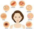 6 in 1 Acne and Pimple Free Soap-100gm. 