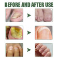 South Moon Toenail Repair Kit Cleansing Nail Nail Nail Thickening Hand & Foot Thickening Nail Repair Kit. 