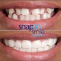 Snap-On Teeth Veneers for Upper & Lower | Comfortable Silicone Denture Covers | Instant Smile Braces. 