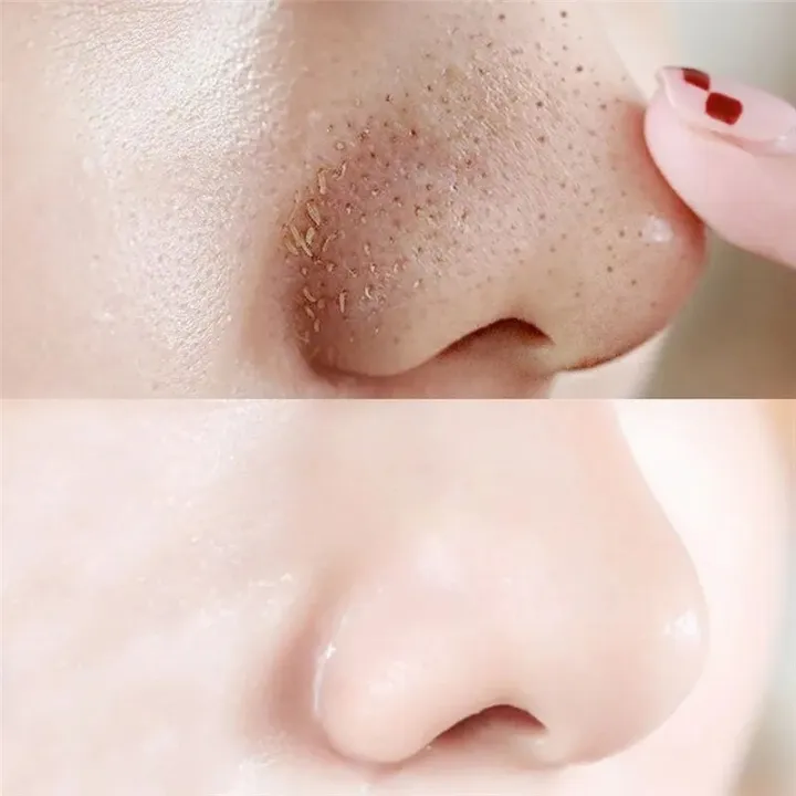 10pcs%20Nose%20Blackhead%20Remover%20Strips%20Mask%20Skin%20Care%20Shrink%20Pore%20Acne%20Treatment%20Mask%20Deep%20Nose%20Pore%20Cleansing%20Strips%20Black%20Head%20Remover,%20Charcoal%20Blackhead%20Remover%20Nose%20Mask%20Strips%20for%20Nose%20Cleansing%20Deep%20Clean%20Treatment%20-%20Image%206