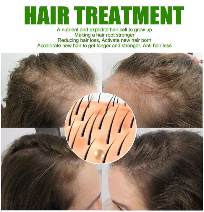 Derma%20Roller%200.5%20Mm%20Hair%20&%20Skin%20System%20-%20High%20quality%20beauty%20dermaroller%20Micro%20pin%20derma%20roller%20540%20needle%20Derma%20Roller%20for%20hair%20regrowth%20facial%20roller%20kit%20-%20Image%204