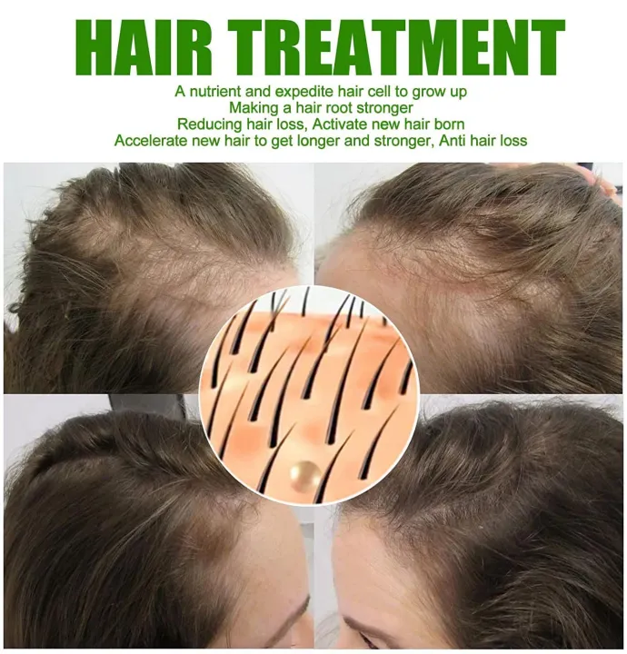 Derma%20Roller%200.5%20Mm%20Hair%20&%20Skin%20System%20-%20High%20quality%20beauty%20dermaroller%20Micro%20pin%20derma%20roller%20540%20needle%20Derma%20Roller%20for%20hair%20regrowth%20facial%20roller%20kit%20-%20Image%204