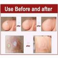 CORN CAP (Foot Care) 5PCS. 