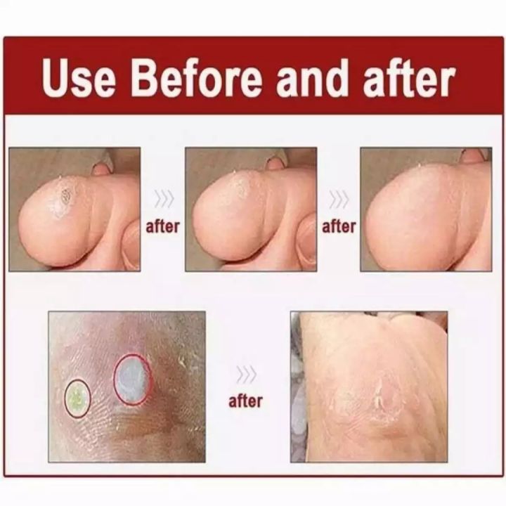 CORN%20CAP%20(Foot%20Care)%205PCS%20-%20Image%205