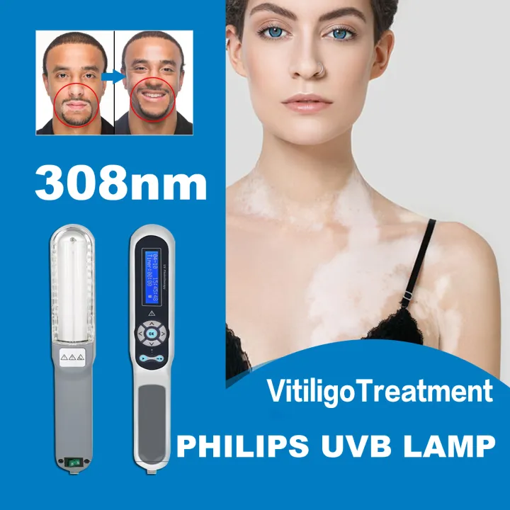 311nm%20UVB%20Ultraviolet%20Phototherapy%20Light%20Instrument%20for%20Vitiligo%20Psoriasis%20Skin%20Treatment%20and%20Therapy%20Treatment%20Lamp%20-%20Image%202