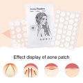Pimple Plaster Gentle Hydrocolloid Acne Patch Remover Absorb Cover. 