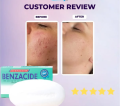 Benzacide Soap ( Treat acne or pimples ) baby skin. 