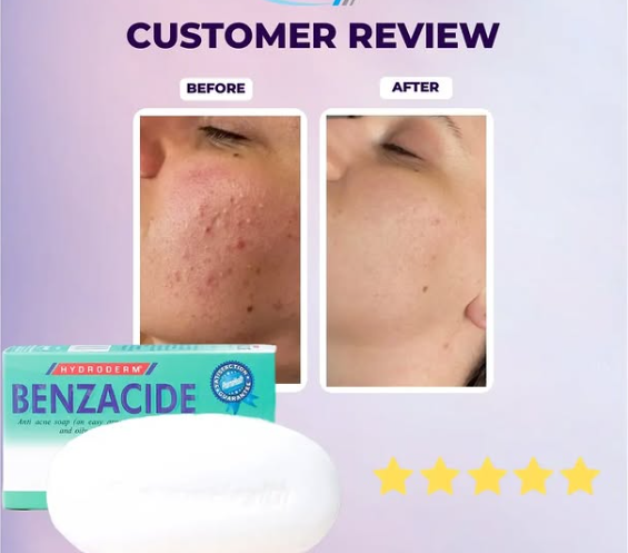 Benzacide Soap ( Treat acne or pimples ) baby skin