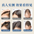 Natural Anti-Hair Loss Hair Growth Agent Grow Dense Hair Hairline Growth Liquid Hair Growth Artifact Hair Growth Artifact Speed Natural. 