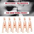 12Pcs Copper Skin Tag Remover Clips Wart Tag Extractor Copper Tag Out. 