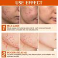 Anti Acne Treatment Scar Removal Cream. 