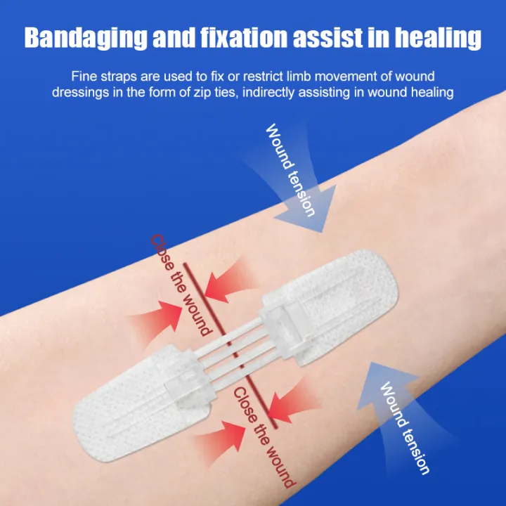 Closure Patch 1 Pcs Band-Aid Zipper Tie Wound Closure Patch Hemostatic Patch Wound ...
