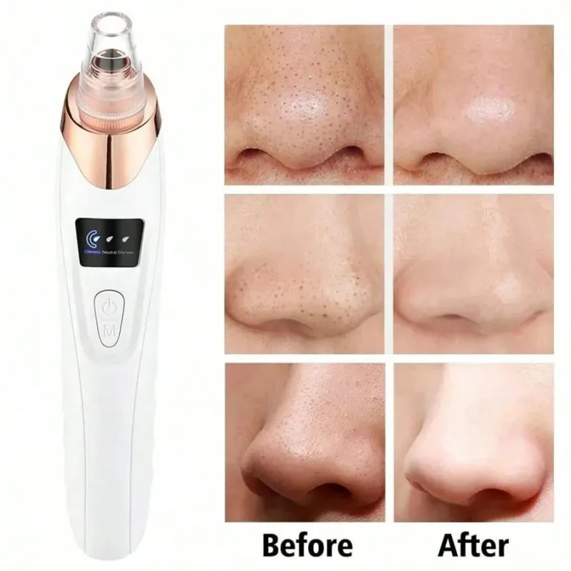 5-in-1 Blackhead Remover Vacuum