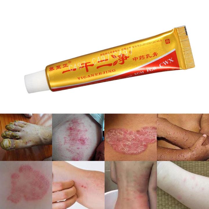 Chinese Medicine Unguentum Cream Eczema Dermatitis Psoriasis Dry Skin ...