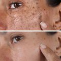 Trimo-skin Cream for Girls Face Pack of 4 | Scar Removal | Hyperpigmentation | Melasma Removal | Skin Care Products | It is applied to the skin and works to even out the skin tone.. 