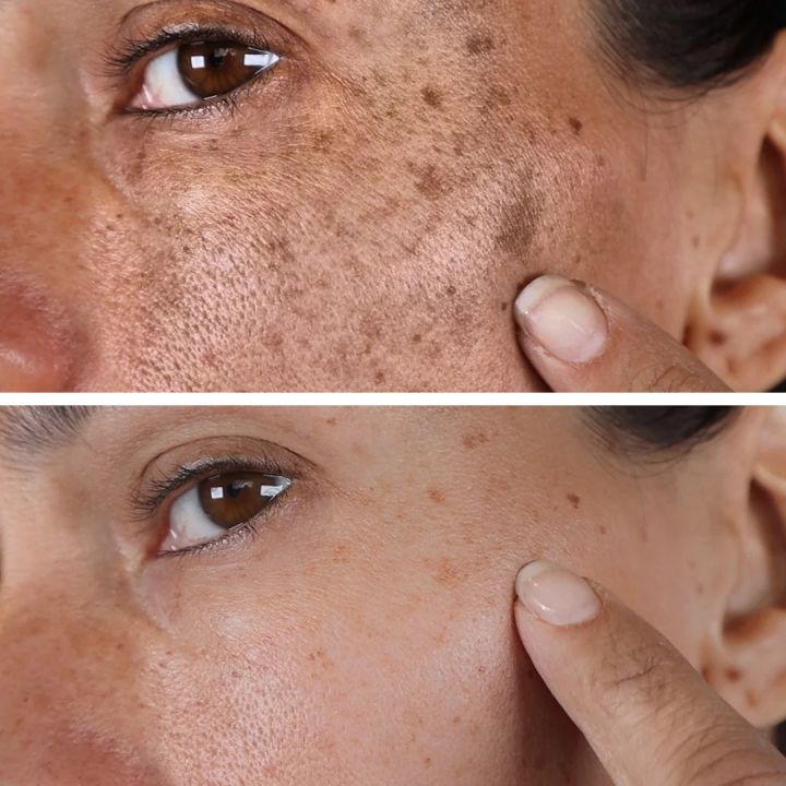 Trimo-skin%20Cream%20for%20Girls%20Face%20Pack%20of%204%20%7C%20Scar%20Removal%20%7C%20Hyperpigmentation%20%7C%20Melasma%20Removal%20%7C%20Skin%20Care%20Products%20%7C%20It%20is%20applied%20to%20the%20skin%20and%20works%20to%20even%20out%20the%20skin%20tone.%20-%20Image%204