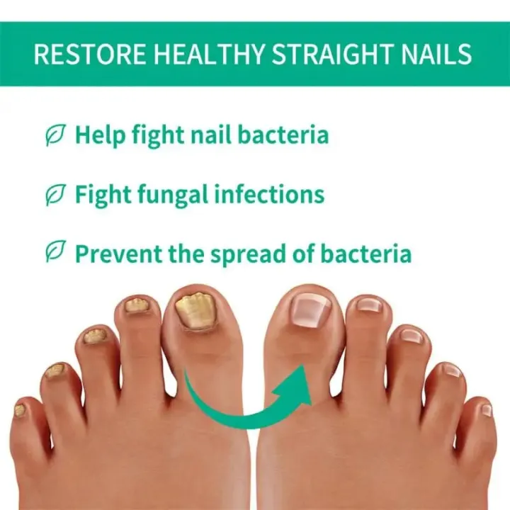 South%20Moon%20Premium%20Nail%20Fungus%20Treatment%20Serum%20-%20Effective%20Nail%20Repair%20&%20Protection%20for%20Onychomycosis%20-%20Image%208