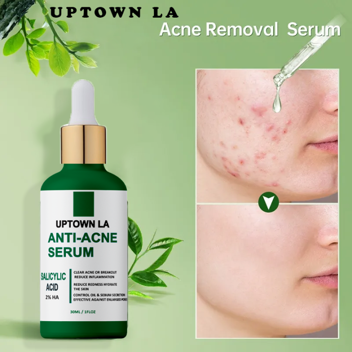 UPTOWN LA Anti Acne serum with Salicylic Acid for oil Control and acne removal 30 ml