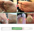 Skin Tag Remover Mole Remover Skin Tag Removal 3ml. 