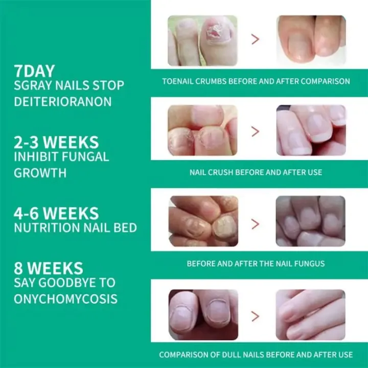 South%20Moon%20Premium%20Nail%20Fungus%20Treatment%20Serum%20-%20Effective%20Nail%20Repair%20&%20Protection%20for%20Onychomycosis%20-%20Image%209