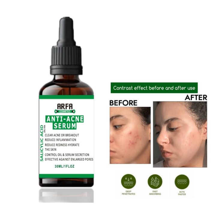 Arfa Cosmetics Salicylic Acid Anti Acne Serum with Salicylic Acid Oil Control and Acne Removal Acne Skin Care Products All Skin Types Use 30Ml