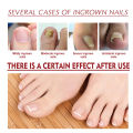 Anti Paronychia Relief Oil Ingrown Toenail Drops Anti Fungal Toe Nail Ingrown Corrector Stop Pain Onychomycosis Treatment Serum. 