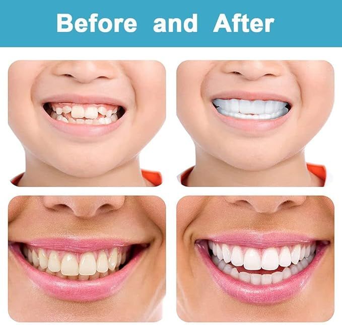TYMO%20Snap-On%20Teeth%20%E2%80%93%20Instant%20Smile%20Makeover%20%7C%20Natural-Looking%20Veneers%20for%20Men%20&%20Women%20%7C%20Comfortable%20&%20Secure%20Fit%20for%20a%20Bright,%20Confident%20Smile%20%7C%20Upper%20&%20Lower%20Teeth%20Covers%20-%20Image%203
